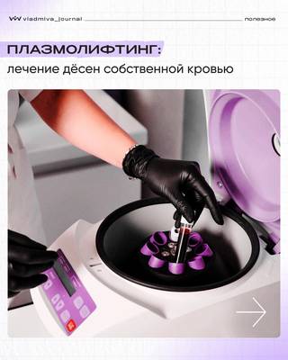 Плазмолифтинг: ресурсы вашего тела для здоровья десен.
